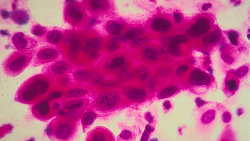 cervical cancer